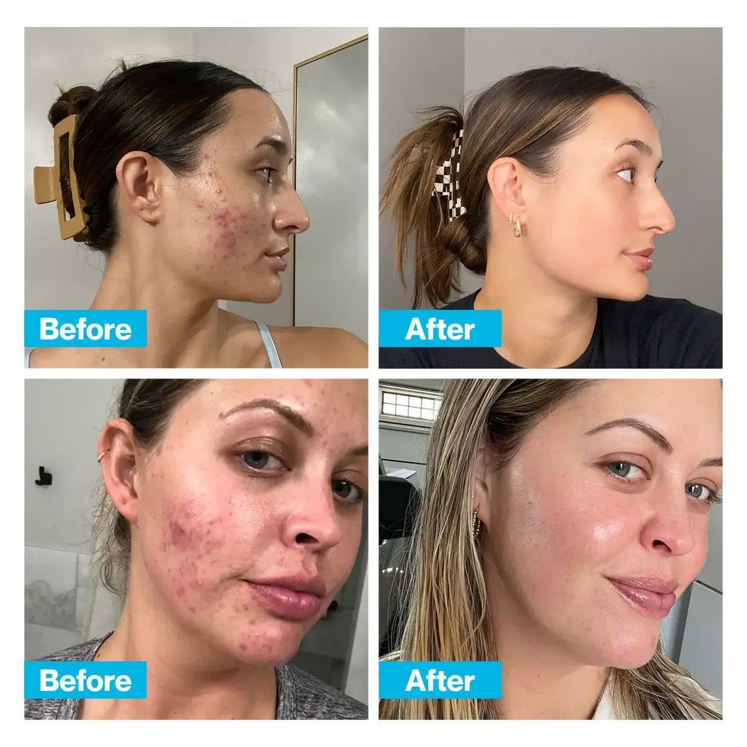 CLEARSKIN™